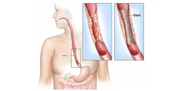 esophageal stenosis